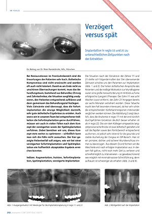 Verzögert versus spät – Implantation in regio 11 und 21