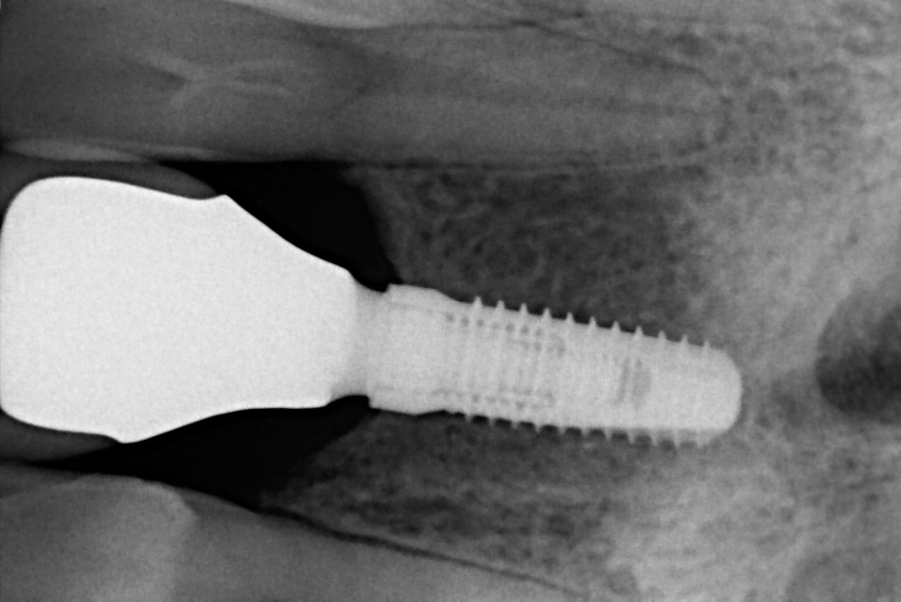 Implantatverluste bei Vitamin D Mangel?