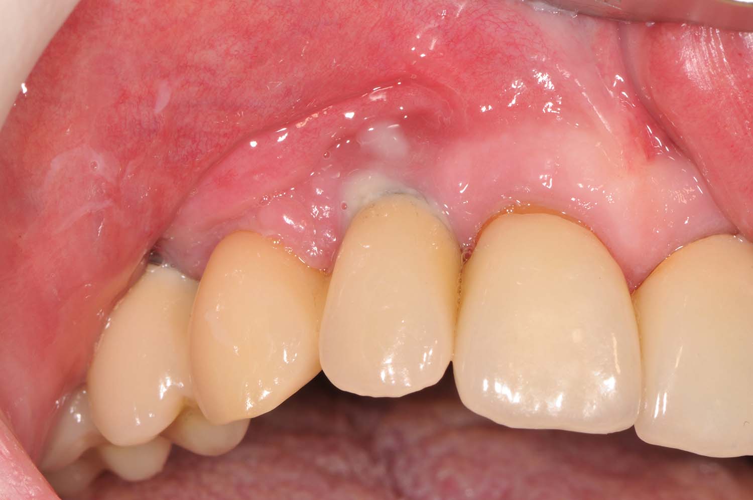 Periimplantitis am Implantat mit Entzündung des Zahnfleischs, Knochenrückgang am Implantat und Eiter