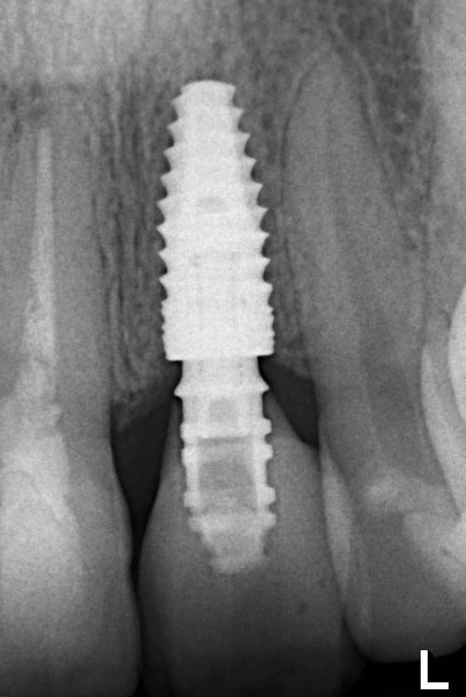 Knochen bis über Implantatschulter, stabile Knochenverhältnisse