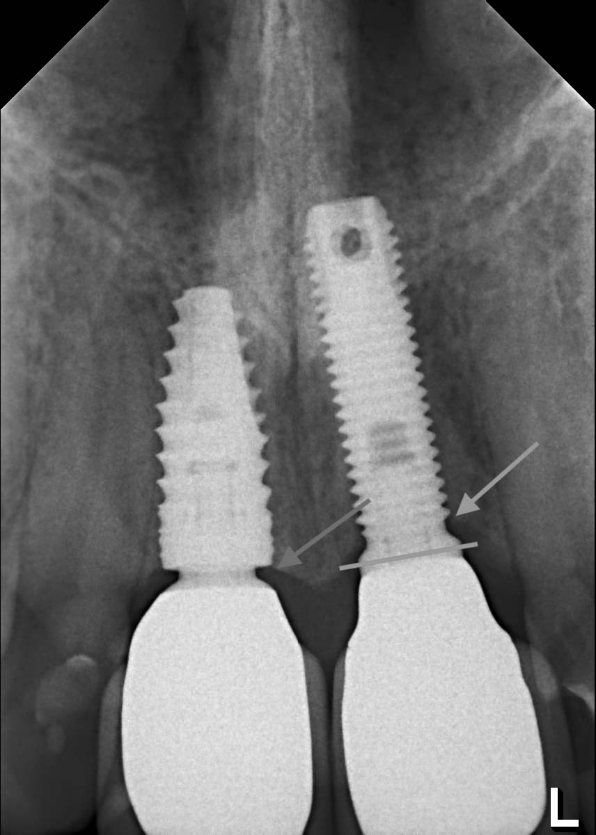 Vergleich modernes Implantat links ohne Knochenabbau, mit altem Implantat rechts mit Knochenabbau