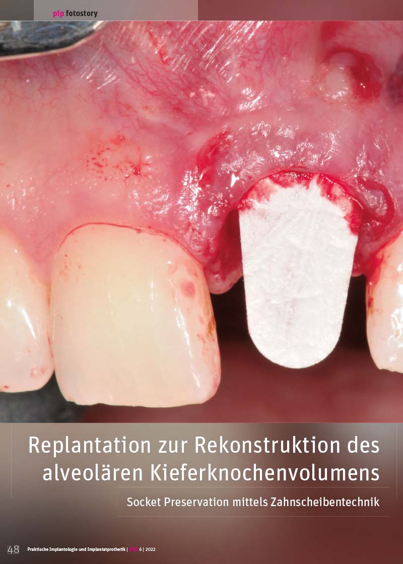 Replantation zur Rekonstruktion des alveolären Kieferknochenvolumens. Socket Preservation mittels Zahnscheibentechnik.