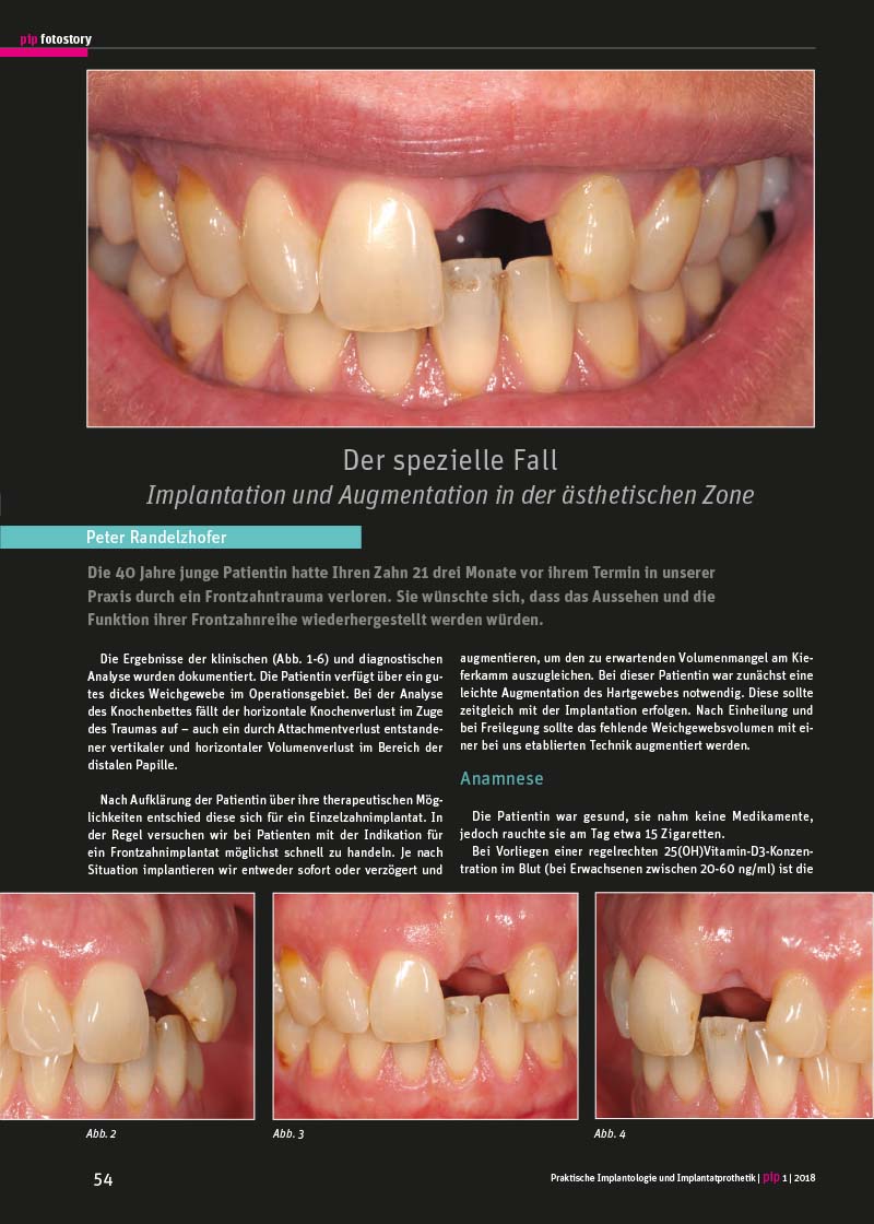 Implantation und Augmentation in der ästhetischen Zone