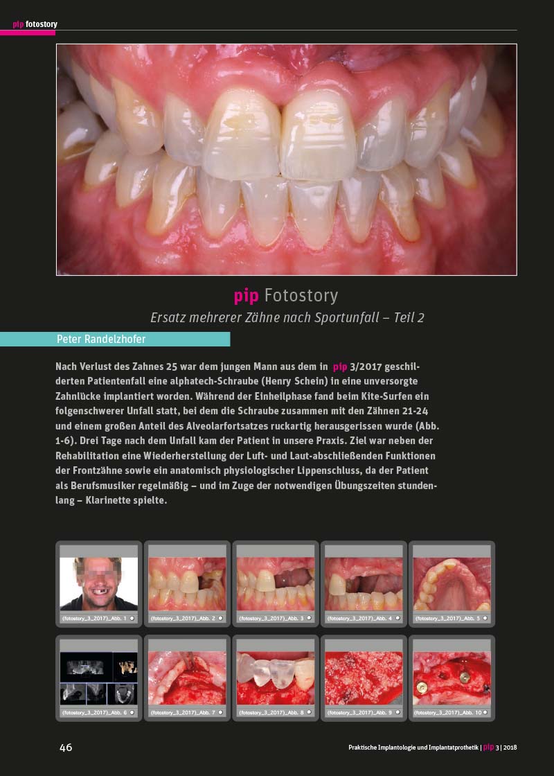 Ersatz mehrerer Zähne nach Sportunfall – Teil 2