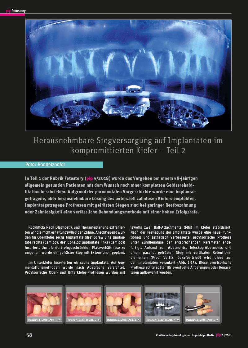 Herausnehmbare Stegversorgung auf Implantaten im kompromittierten Kiefer – Teil 2