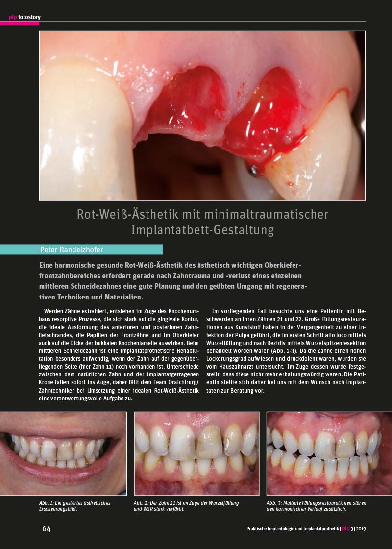 Rot-Weiß-Ästhetik mit minimaltraumatischer Implantatbett-Gestaltung