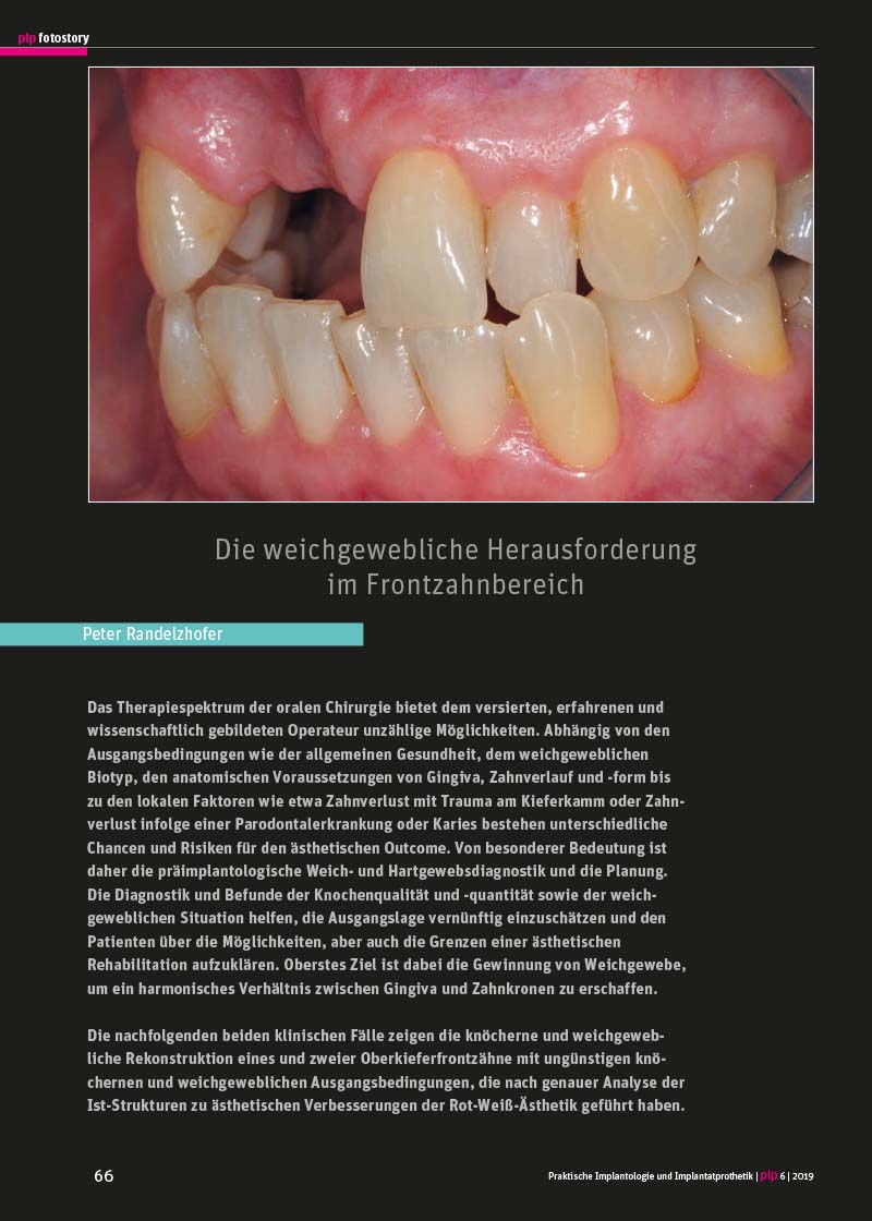 Die weichgewebliche Herausforderung im Frontzahnbereich