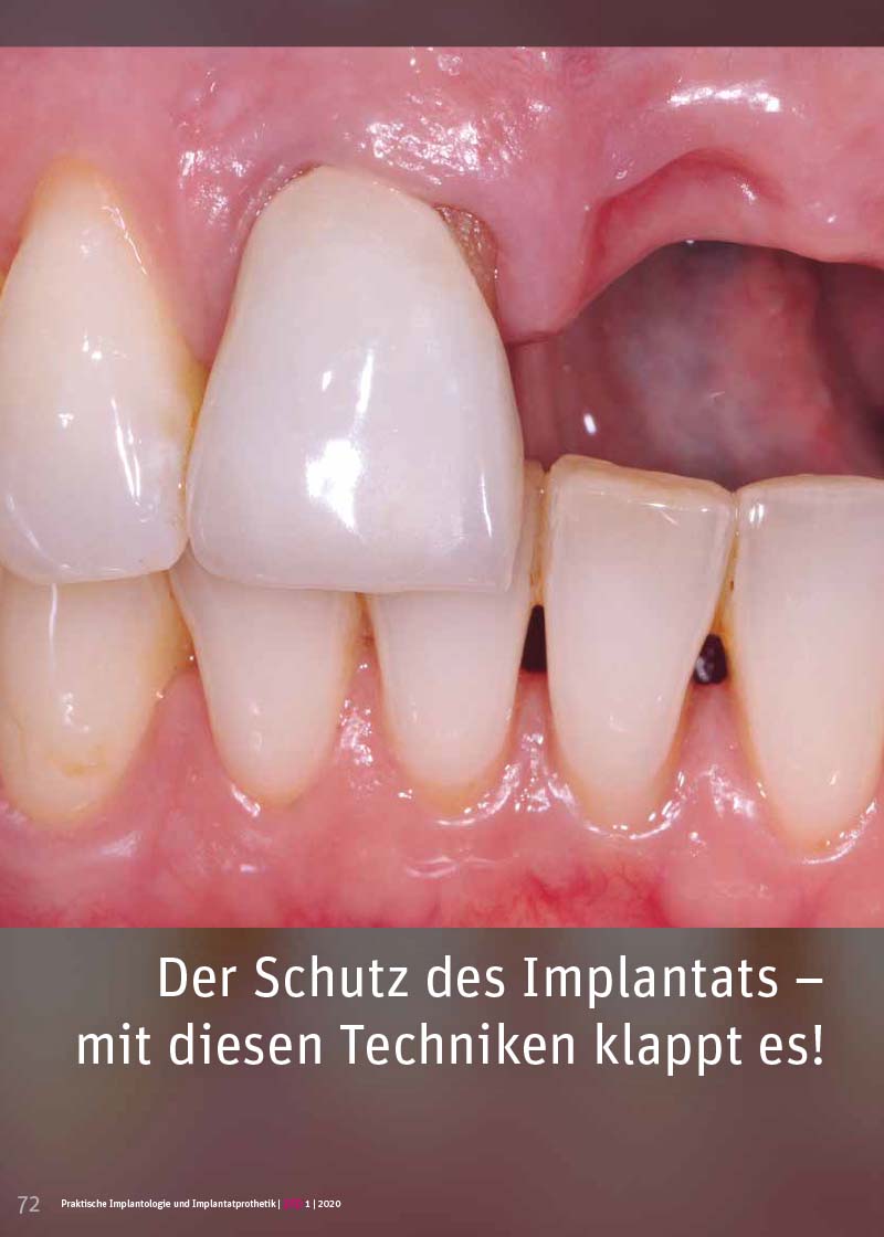 Der Schutz des Implantats – mit diesen Techniken klappt es!