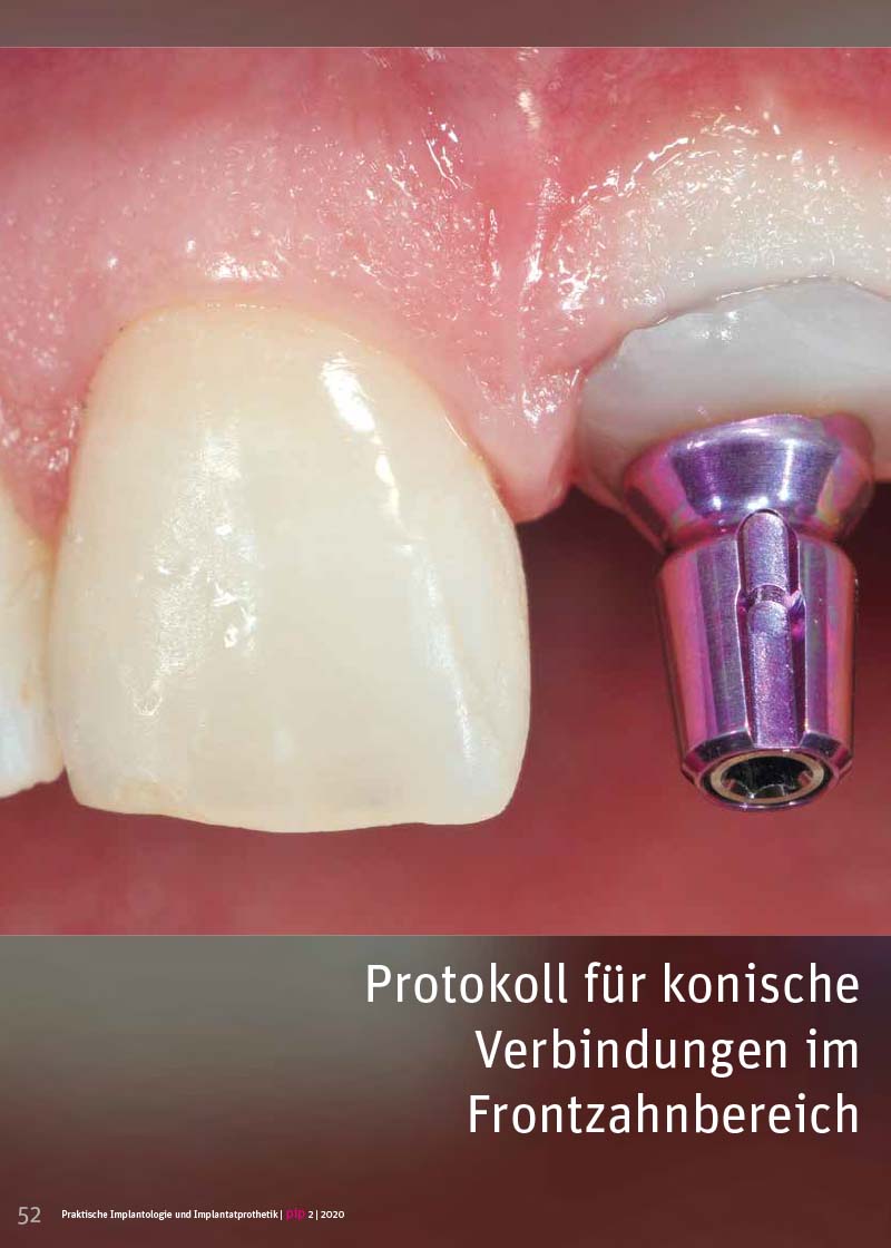 Protokoll für konische Verbindungen im Frontzahnbereich