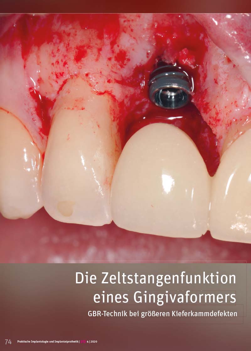 Die Zeltstangenfunktion eines Gingivaformers