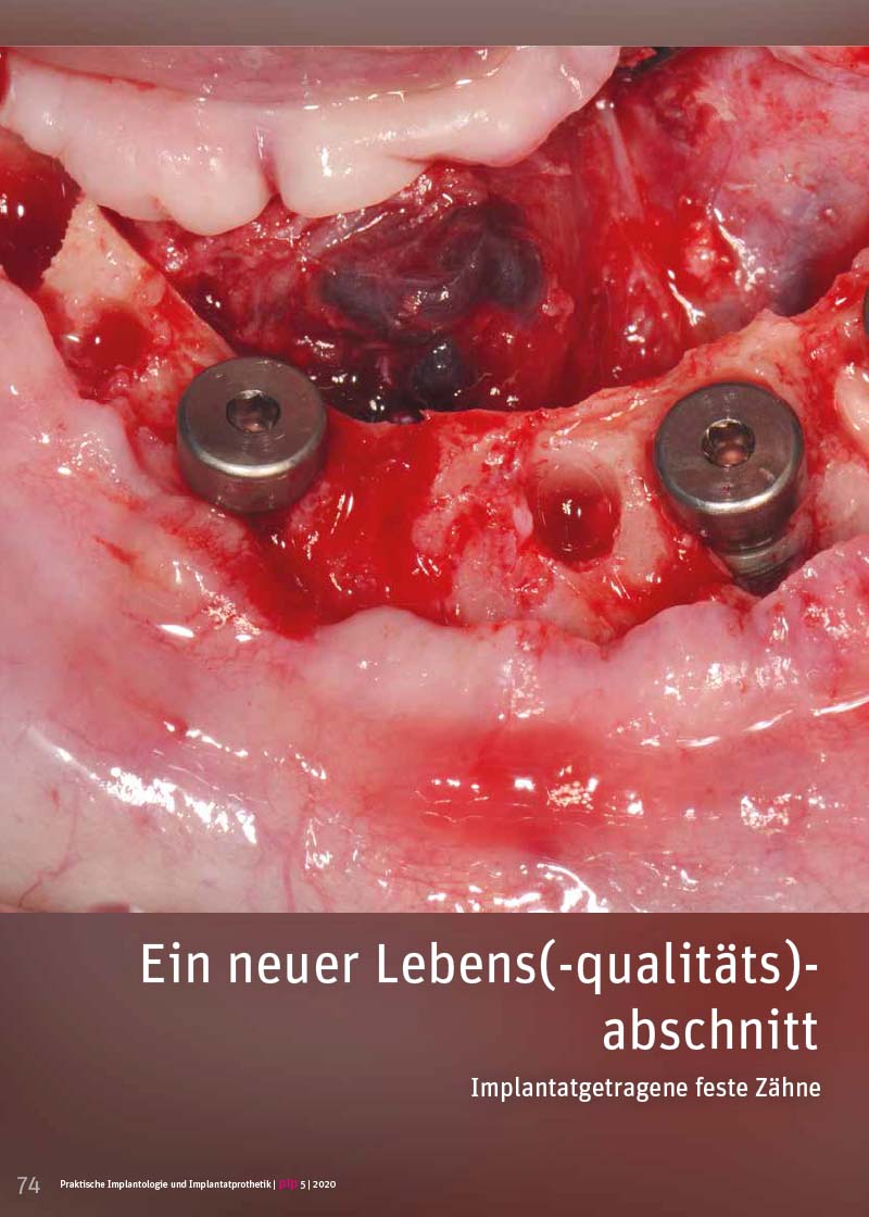 Implantatgetragene feste Zähne, Teil 1