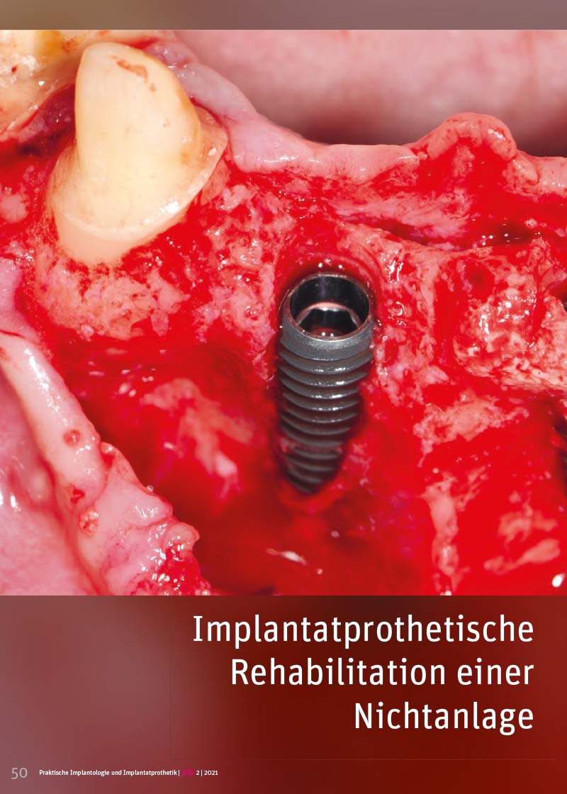 Implantatprothetische Rehabilitation einer Nichtanlage