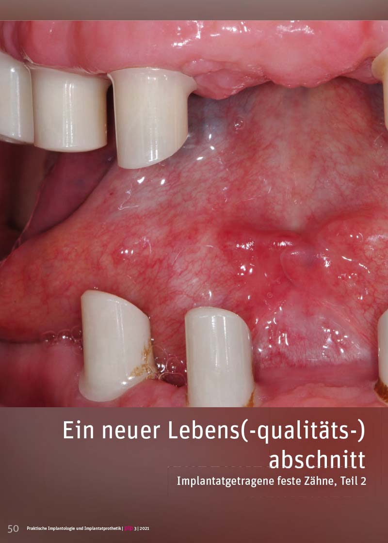 Implantatgetragene feste Zähne, Teil 2