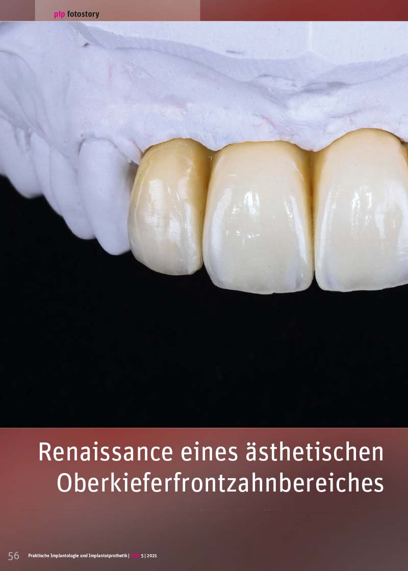 Renaissance eines ästhetischen Oberkieferfrontzahnbereiches