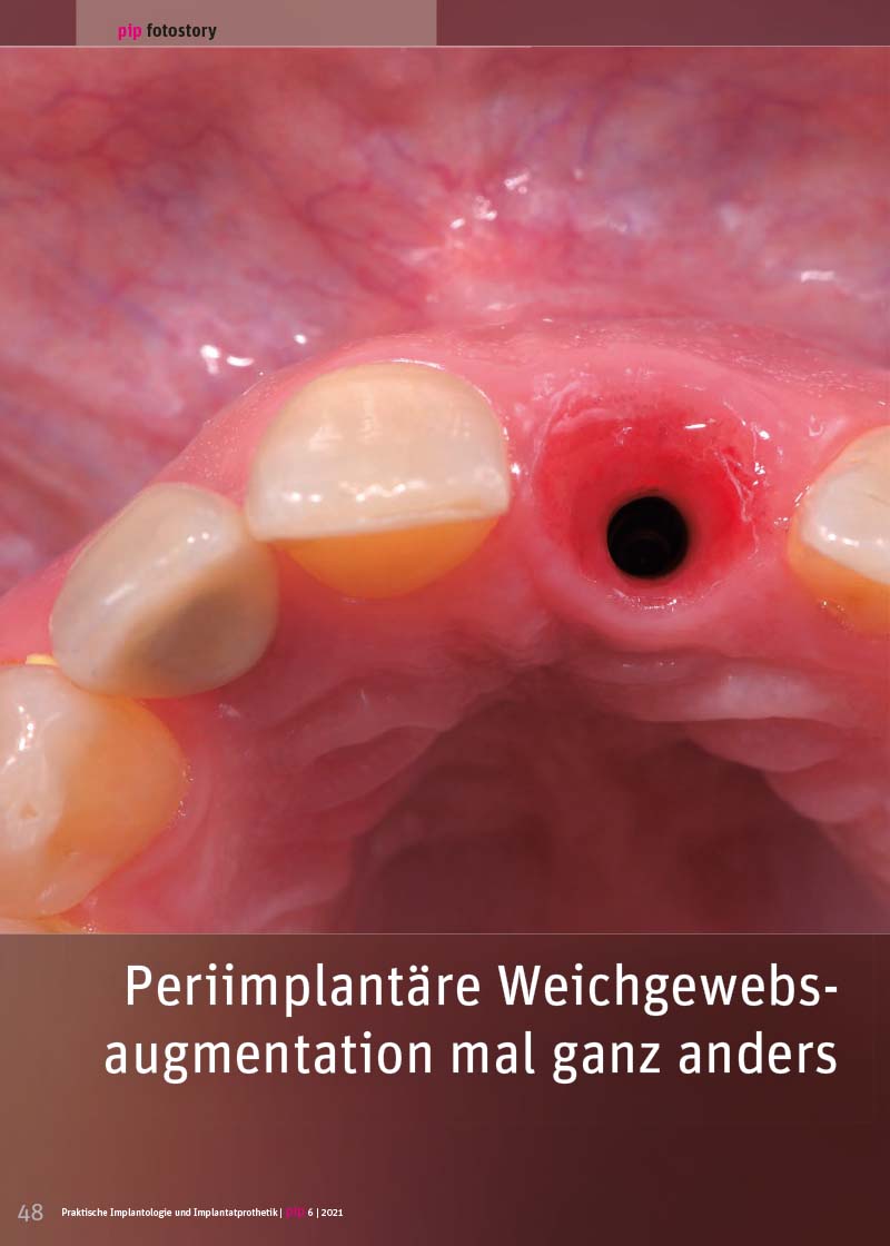 Periimplantäre Weichgewebsaugmentation mal ganz anders