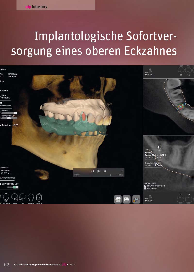 Implantologische Sofortversorgung eines oberen Eckzahnes